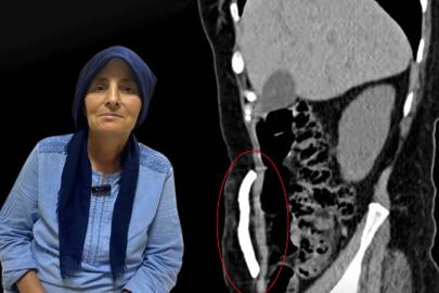 Manisa'da bir ilk. Karın boşluğunda aylarca kafatası kemiği taşıdı, sağlığına kavuştu